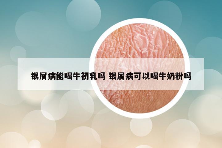 银屑病能喝牛初乳吗 银屑病可以喝牛奶粉吗