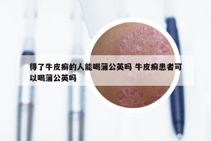 得了牛皮癣的人能喝蒲公英吗 牛皮癣患者可以喝蒲公英吗