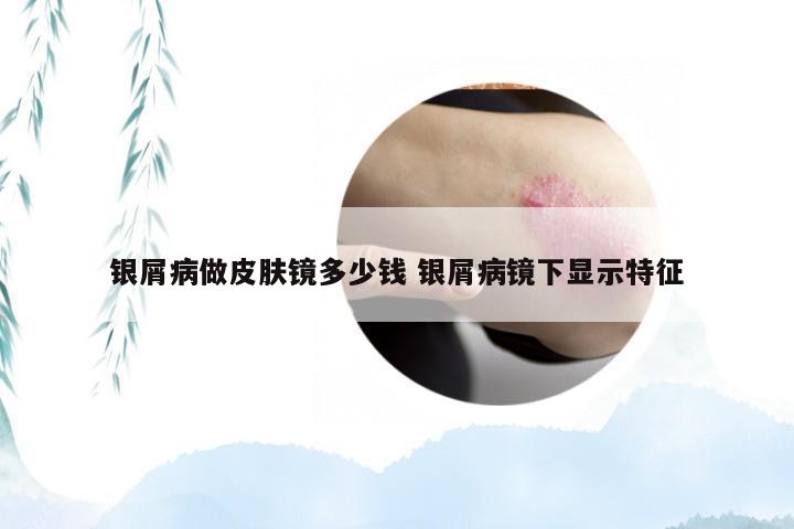 银屑病做皮肤镜多少钱 银屑病镜下显示特征