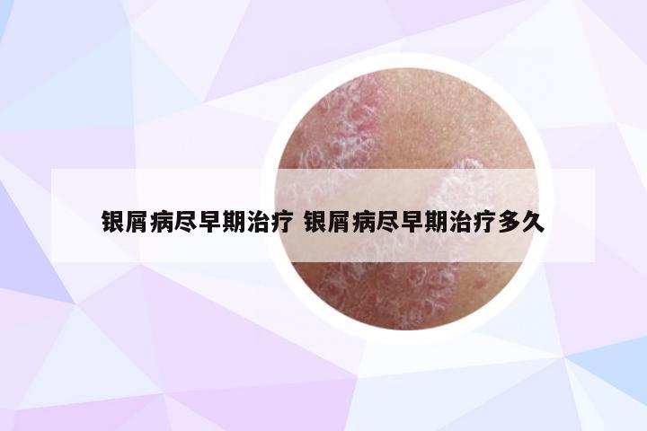 银屑病尽早期治疗 银屑病尽早期治疗多久