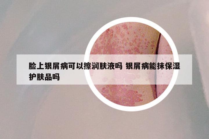 脸上银屑病可以擦润肤液吗 银屑病能抹保湿护肤品吗