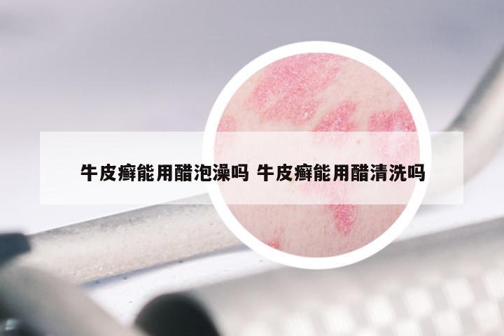 牛皮癣能用醋泡澡吗 牛皮癣能用醋清洗吗