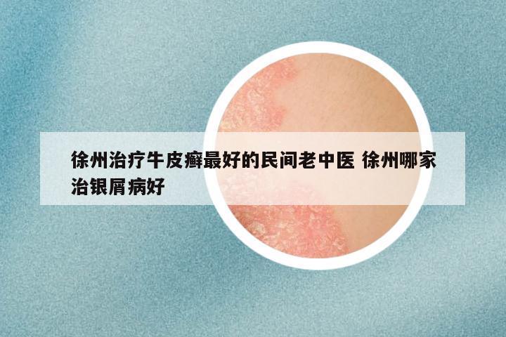 徐州治疗牛皮癣最好的民间老中医 徐州哪家治银屑病好