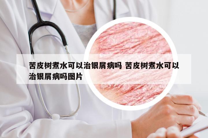 苦皮树煮水可以治银屑病吗 苦皮树煮水可以治银屑病吗图片