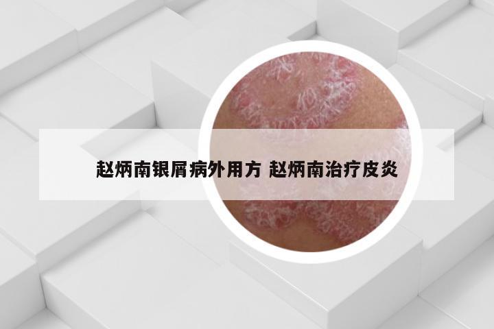 赵炳南银屑病外用方 赵炳南治疗皮炎