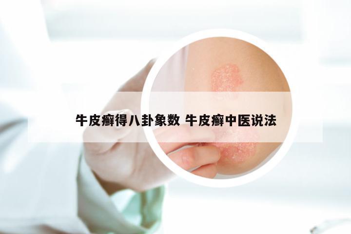 牛皮癣得八卦象数 牛皮癣中医说法
