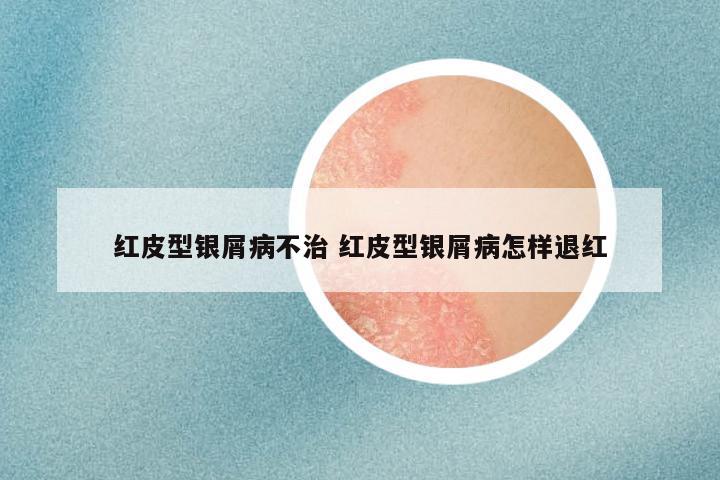 红皮型银屑病不治 红皮型银屑病怎样退红