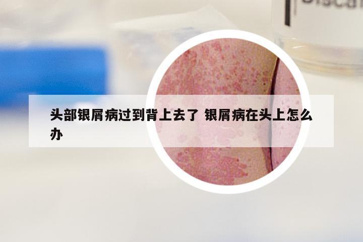 头部银屑病过到背上去了 银屑病在头上怎么办