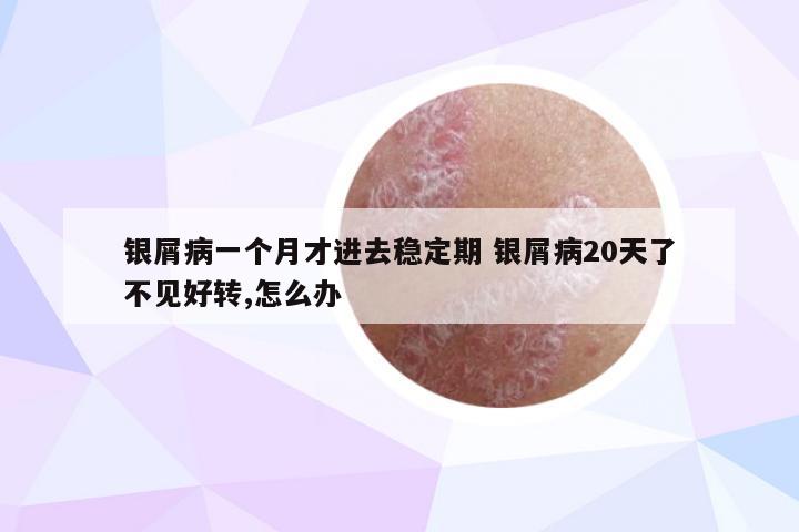银屑病一个月才进去稳定期 银屑病20天了不见好转,怎么办