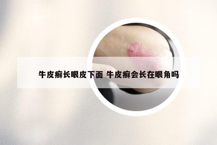 牛皮癣长眼皮下面 牛皮癣会长在眼角吗