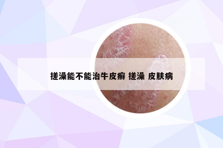 搓澡能不能治牛皮癣 搓澡 皮肤病