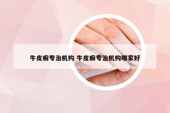 牛皮癣专治机构 牛皮癣专治机构哪家好