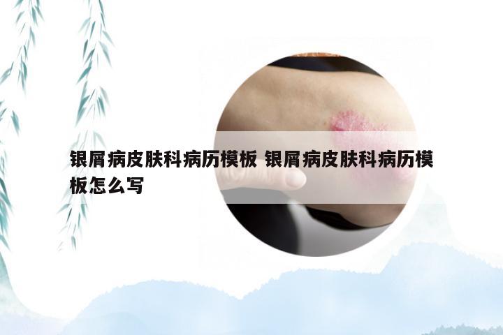 银屑病皮肤科病历模板 银屑病皮肤科病历模板怎么写