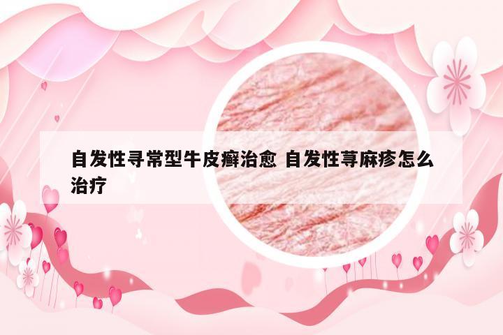 自发性寻常型牛皮癣治愈 自发性荨麻疹怎么治疗