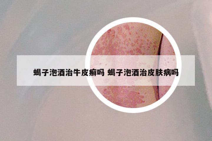 蝎子泡酒治牛皮癣吗 蝎子泡酒治皮肤病吗