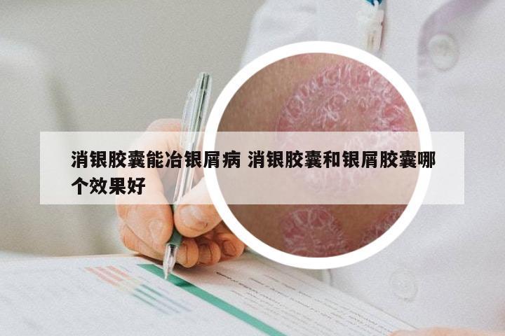消银胶囊能冶银屑病 消银胶囊和银屑胶囊哪个效果好