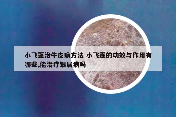 小飞蓬治牛皮癣方法 小飞蓬的功效与作用有哪些,能治疗银屑病吗