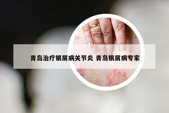青岛治疗银屑病关节炎 青岛银屑病专家