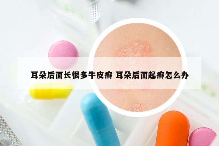 耳朵后面长很多牛皮癣 耳朵后面起癣怎么办