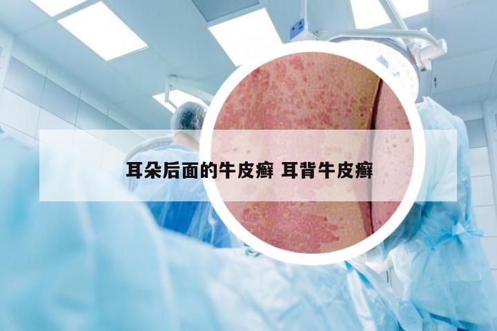 耳朵后面的牛皮癣 耳背牛皮癣
