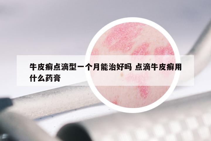 牛皮癣点滴型一个月能治好吗 点滴牛皮癣用什么药膏