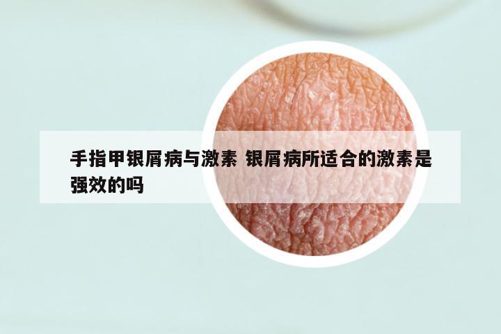 手指甲银屑病与激素 银屑病所适合的激素是强效的吗
