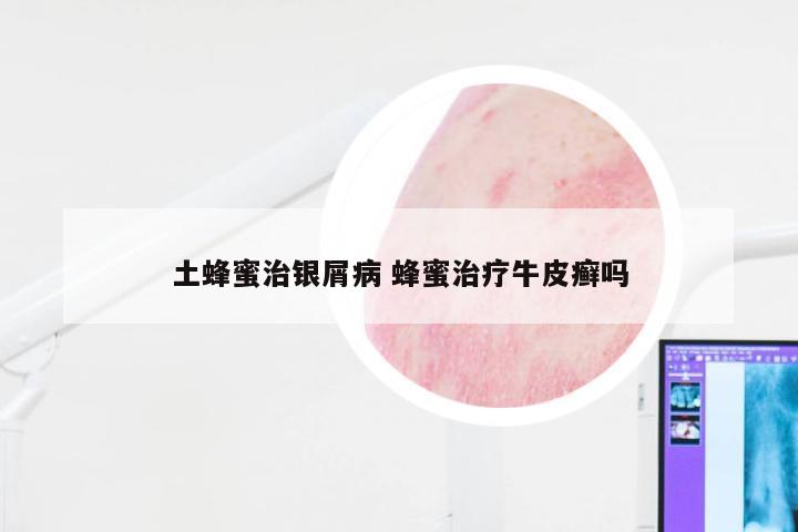 土蜂蜜治银屑病 蜂蜜治疗牛皮癣吗