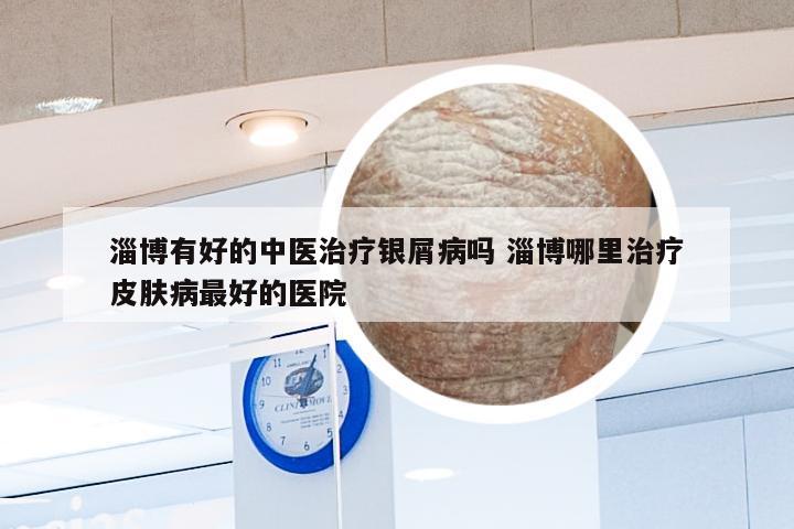 淄博有好的中医治疗银屑病吗 淄博哪里治疗皮肤病最好的医院