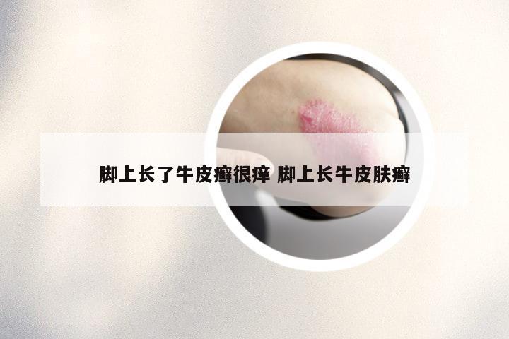 脚上长了牛皮癣很痒 脚上长牛皮肤癣