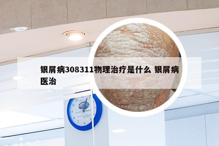 银屑病308311物理治疗是什么 银屑病医治