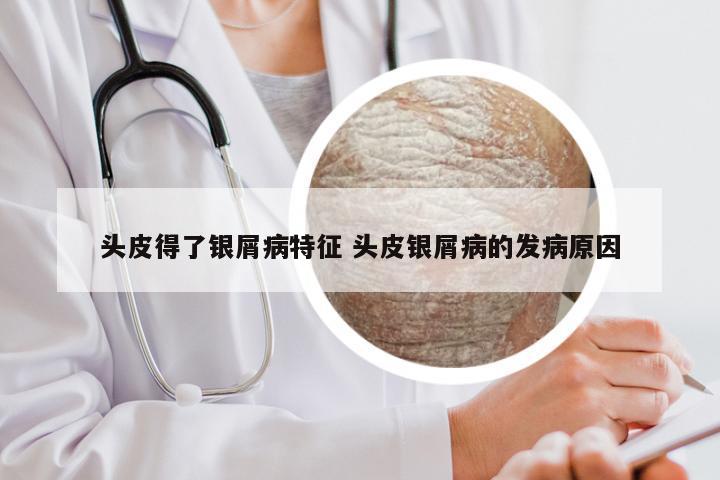 头皮得了银屑病特征 头皮银屑病的发病原因