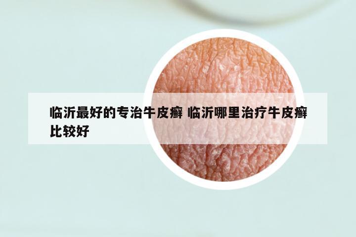 临沂最好的专治牛皮癣 临沂哪里治疗牛皮癣比较好
