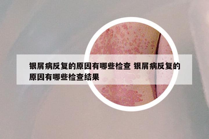 银屑病反复的原因有哪些检查 银屑病反复的原因有哪些检查结果