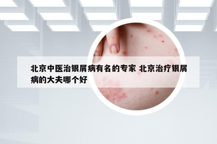 北京中医治银屑病有名的专家 北京治疗银屑病的大夫哪个好