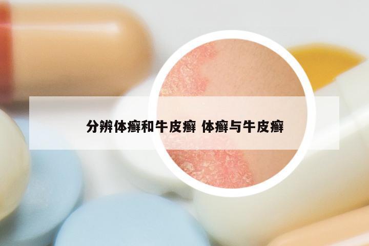 分辨体癣和牛皮癣 体癣与牛皮癣
