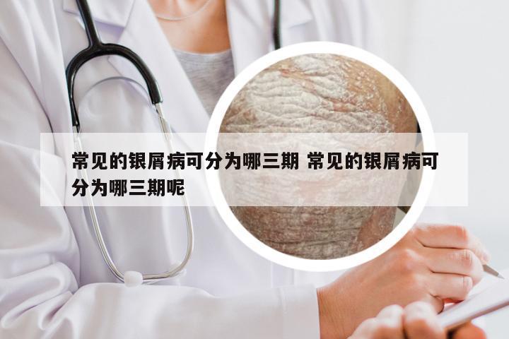 常见的银屑病可分为哪三期 常见的银屑病可分为哪三期呢