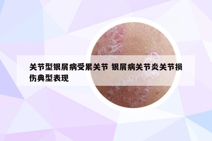 关节型银屑病受累关节 银屑病关节炎关节损伤典型表现