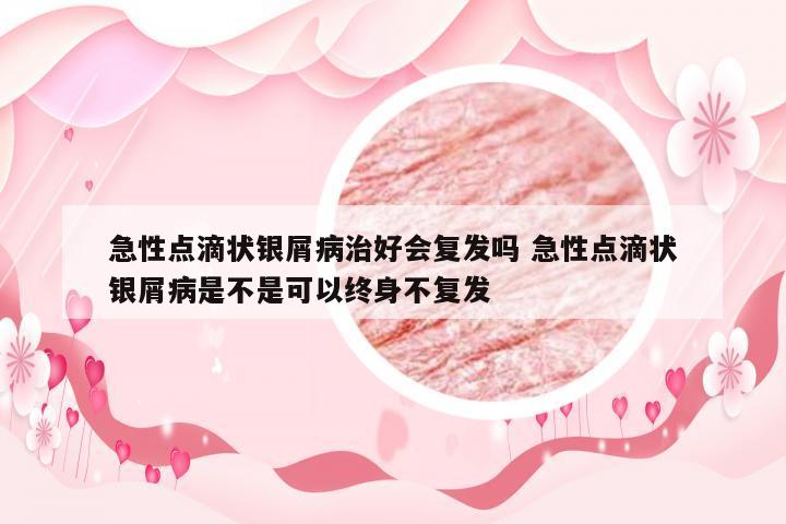 急性点滴状银屑病治好会复发吗 急性点滴状银屑病是不是可以终身不复发