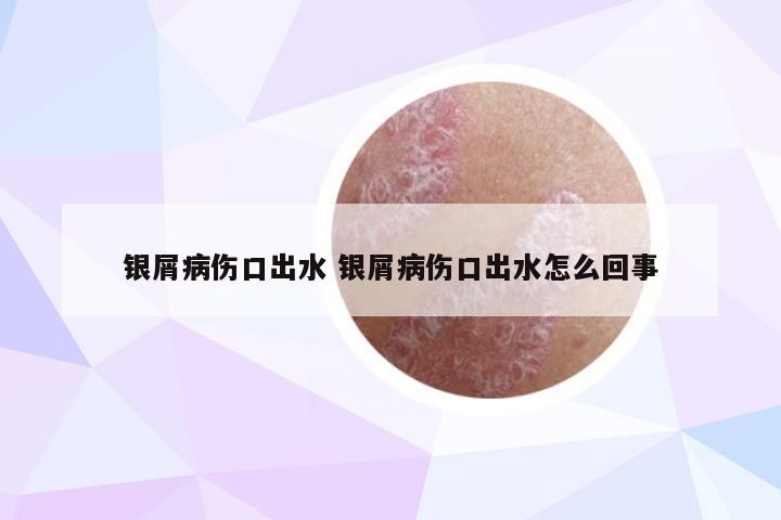 银屑病伤口出水 银屑病伤口出水怎么回事