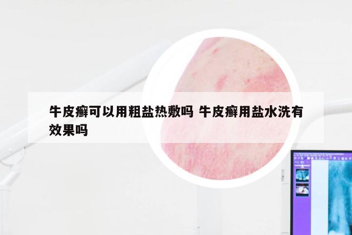 牛皮癣可以用粗盐热敷吗 牛皮癣用盐水洗有效果吗