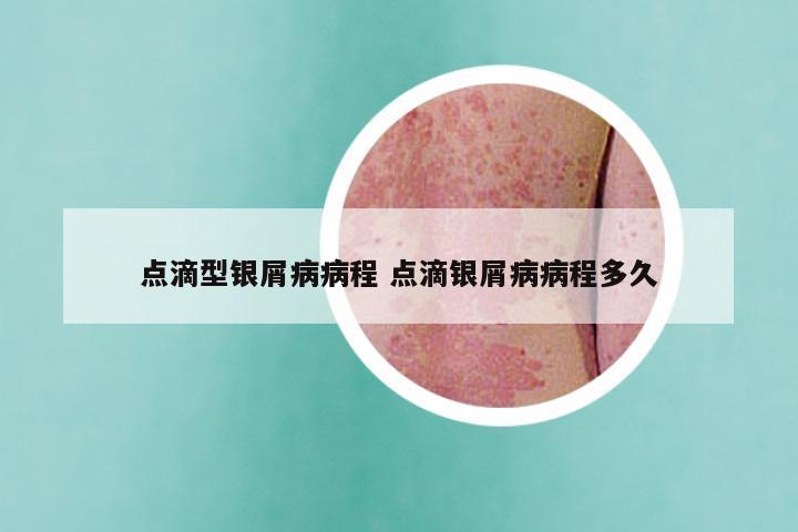 点滴型银屑病病程 点滴银屑病病程多久
