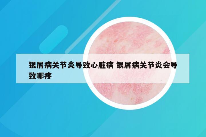 银屑病关节炎导致心脏病 银屑病关节炎会导致哪疼