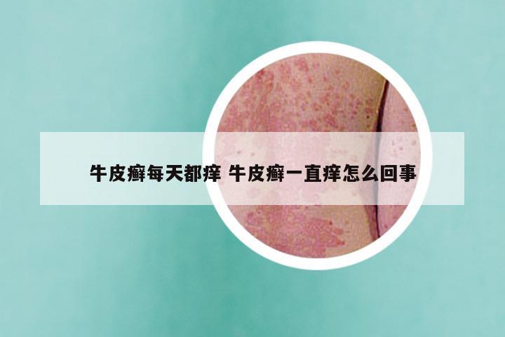 牛皮癣每天都痒 牛皮癣一直痒怎么回事