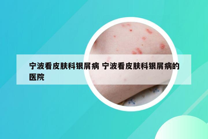 宁波看皮肤科银屑病 宁波看皮肤科银屑病的医院