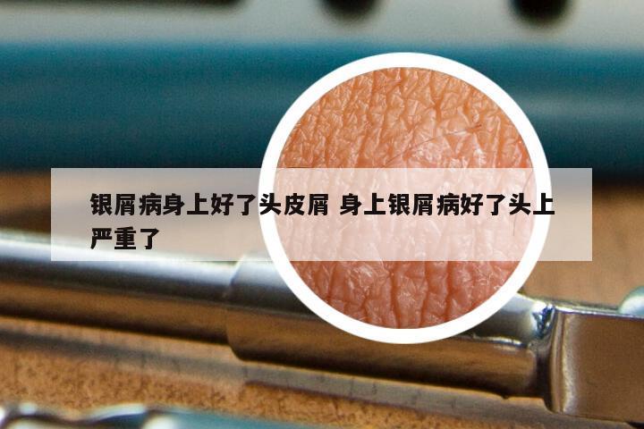 银屑病身上好了头皮屑 身上银屑病好了头上严重了