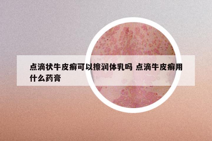 点滴状牛皮癣可以擦润体乳吗 点滴牛皮癣用什么药膏