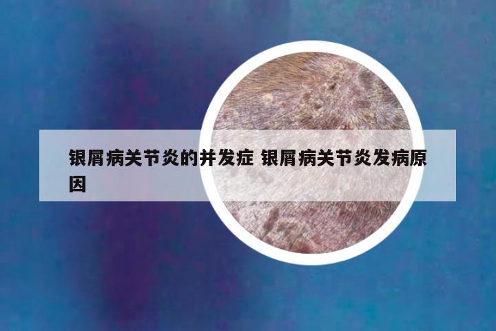 银屑病关节炎的并发症 银屑病关节炎发病原因
