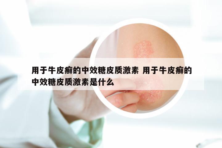 用于牛皮癣的中效糖皮质激素 用于牛皮癣的中效糖皮质激素是什么