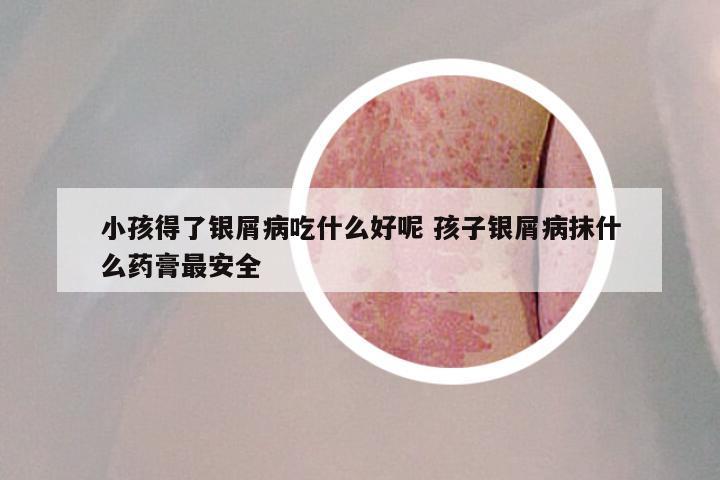 小孩得了银屑病吃什么好呢 孩子银屑病抹什么药膏最安全