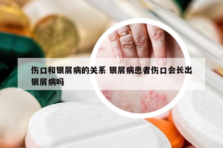 伤口和银屑病的关系 银屑病患者伤口会长出银屑病吗